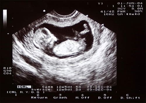 echographie 2eme trimestre echographie 2eme trimestre
